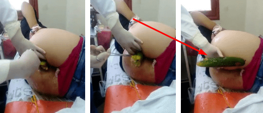 Doctor le saco de emergencia un pepino